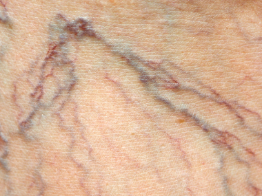 Close-up de pele de doente com varizes