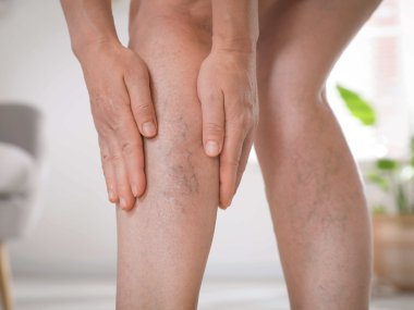 Pernas com presença de varizes