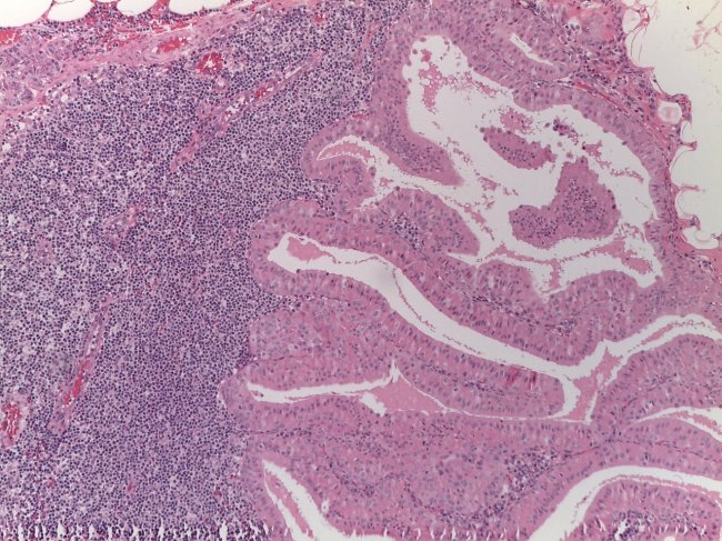 tumor benigno das glândulas salivares