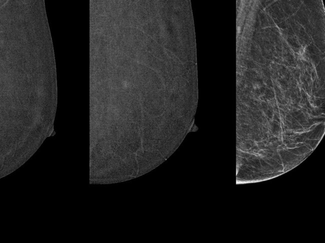 Mamografia de Contraste