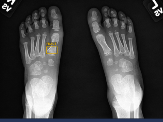 osso-partido-gleamer