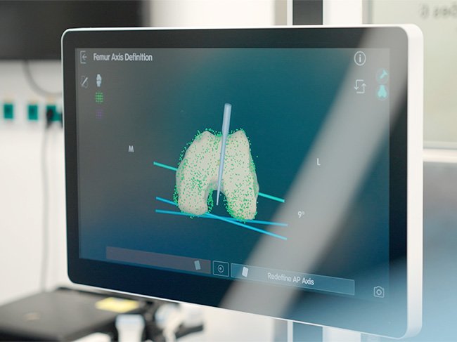 Imagem de joelho vista em ecrã numa cirurgia.