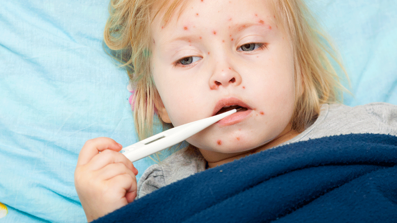 Criança manifesta sintomas de doenças exantemáticas