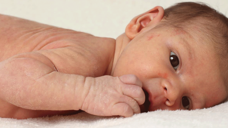 bebé com eczema deitado na cama