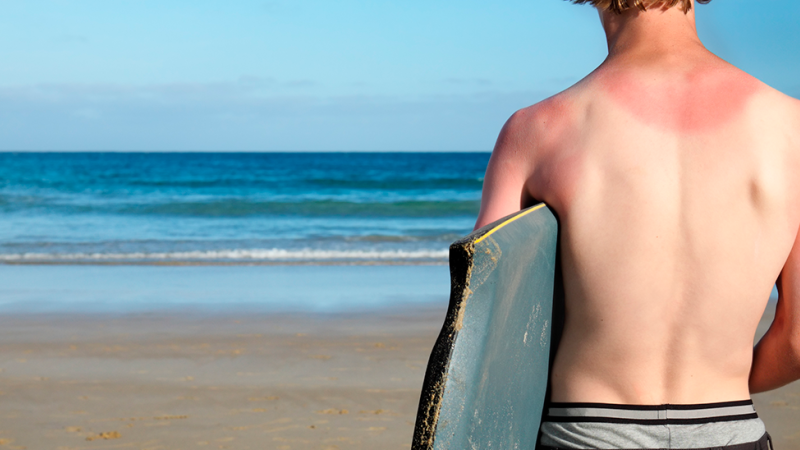 Homem na praia com escaldão