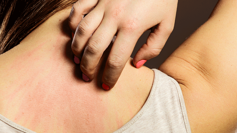 Mulher com sintomas de sarna humana a coçar-se