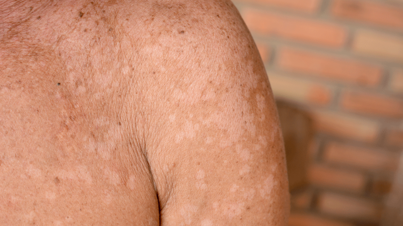 homem com pitiríase versicolor