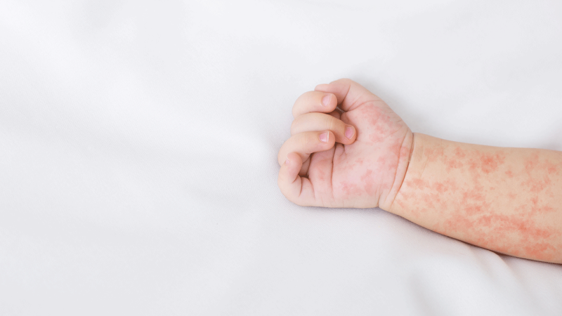 Braço de bebé com sarampo