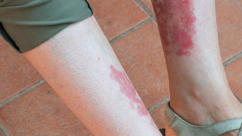 Sintomas da Vasculite