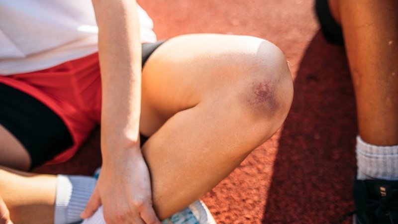 Close-up de perna com nódoas negras