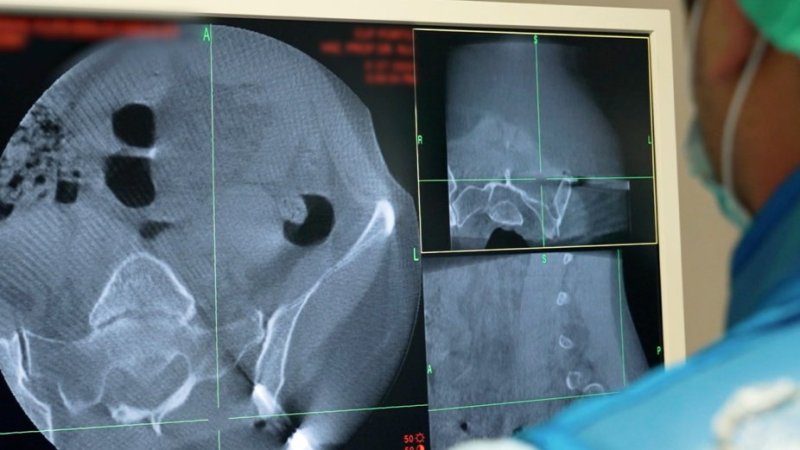 Monitor com imagens captadas com O-arm durante cirurgia