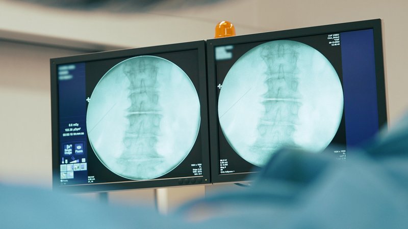 Técnicas minimamente invasivas de cirurgia da coluna