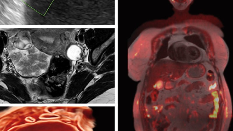 Uma colagem de quatro imagens médicas diagnósticas dividida em duas colunas, com foco em exames ginecológicos e oncológicos.