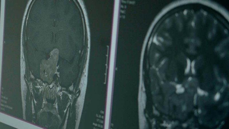 Imagem de tumor da hipófise