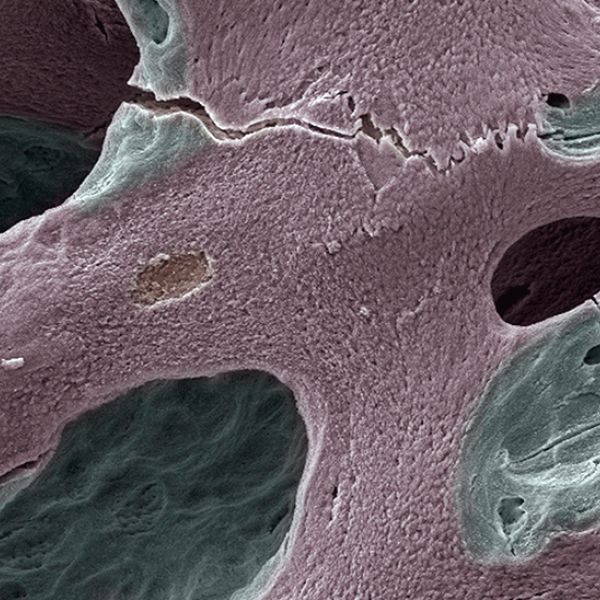 Exame diagnóstico de osso de doente com osteoporose