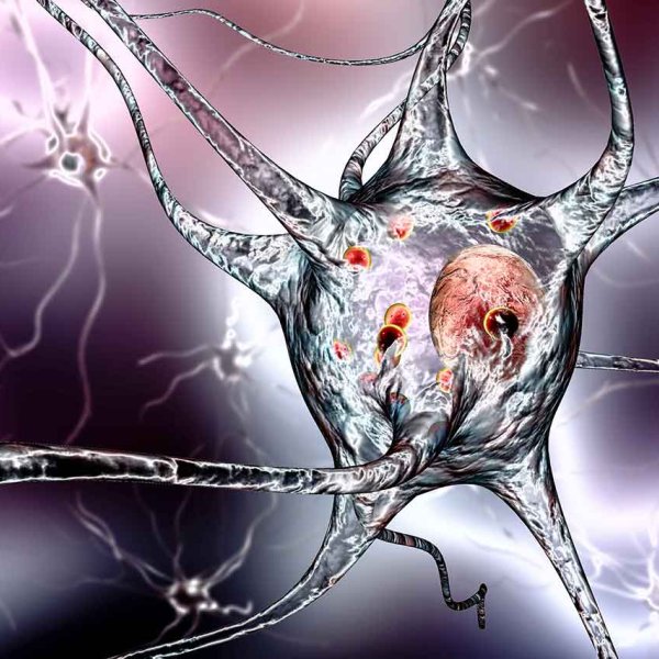 Ilustração de célula nervosa de indivíduo com doença de Parkinson