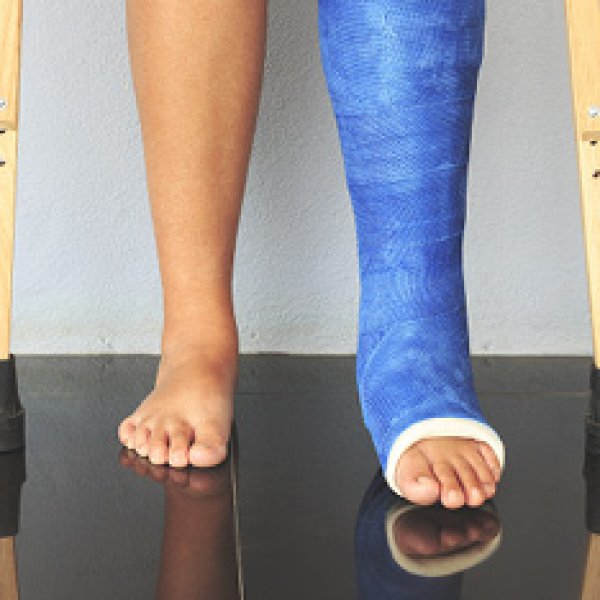 Um par de pés, um deles com gesso