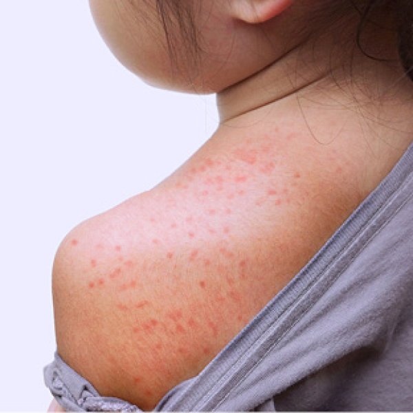 Pele de criança irritada