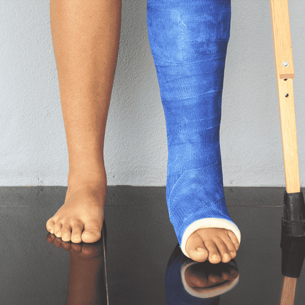 Pessoa em pé com as pernas visíveis. Uma perna descalça e a outra imobilizada com um gesso azul até ao pé, apoiadas com muletas.