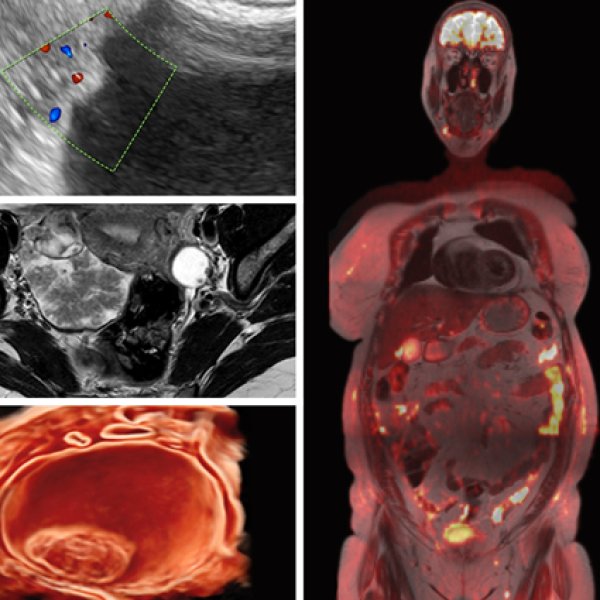 Uma colagem de quatro imagens médicas diagnósticas dividida em duas colunas, com foco em exames ginecológicos e oncológicos.