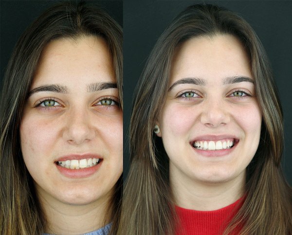 testemunho_catarina-sardo_antes-depois_medicina_dentaria