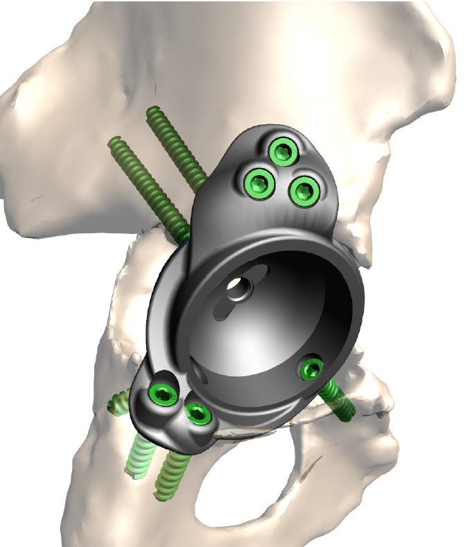 Modelo prótese de anca personalizada