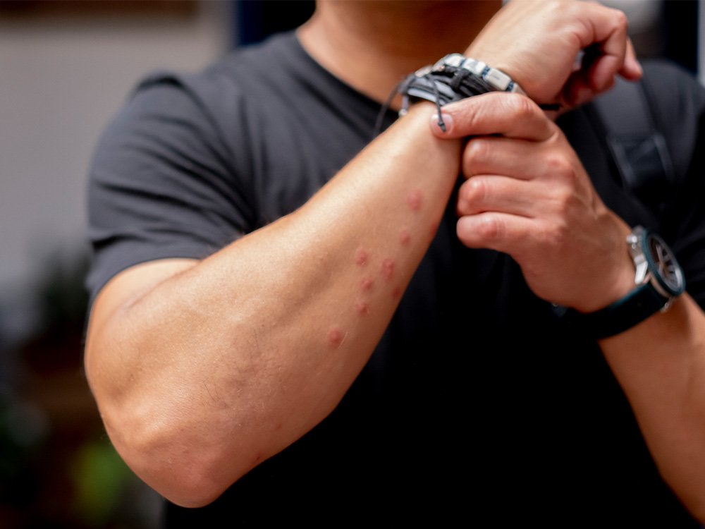 Reação alérgica ao percevejo, no braço de um homem.