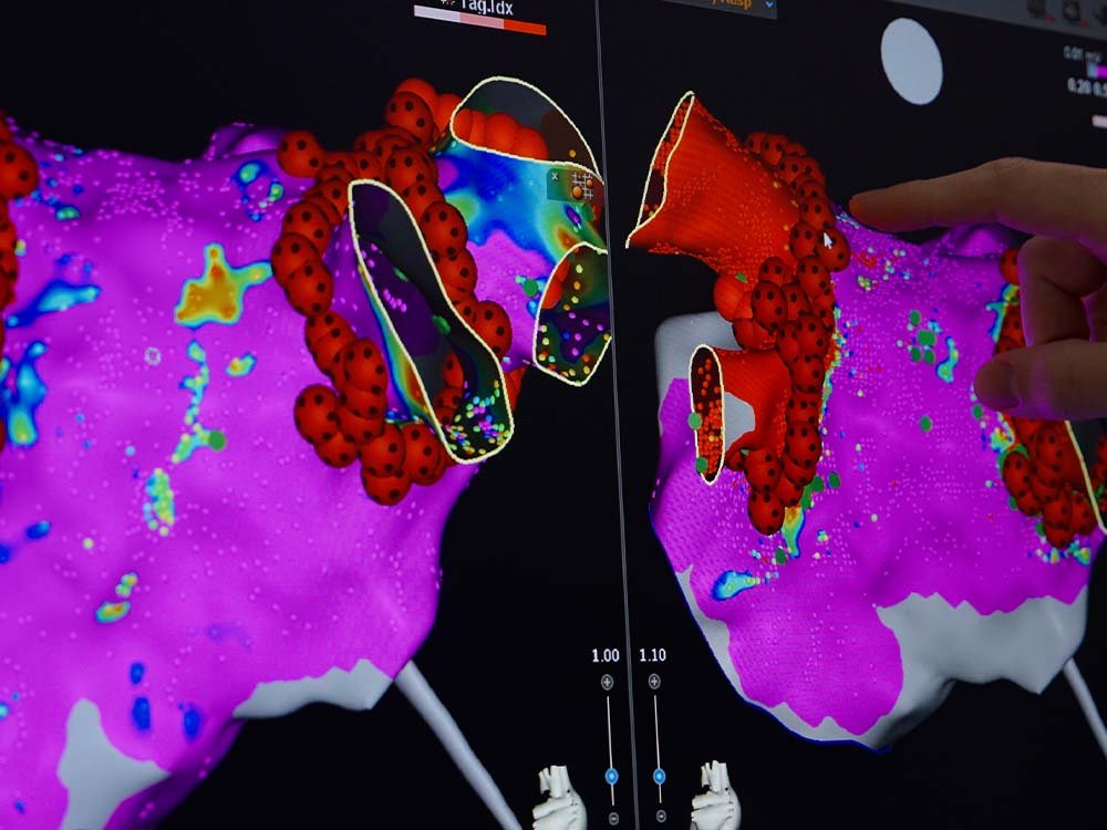 Imagem de painel de cirurgia de ablação.