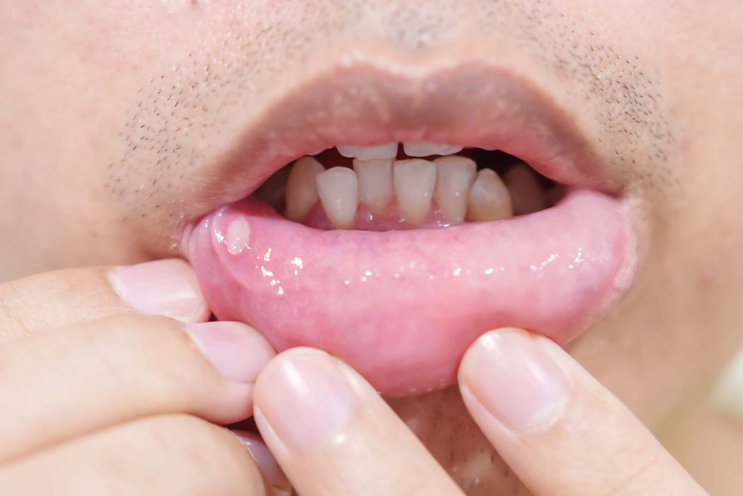 Homem mostra afta no lábio.