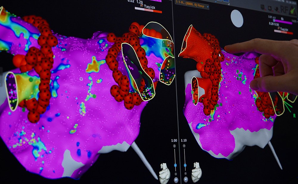 Modelo 3D do coração durante uma ablação para tratar arritmia