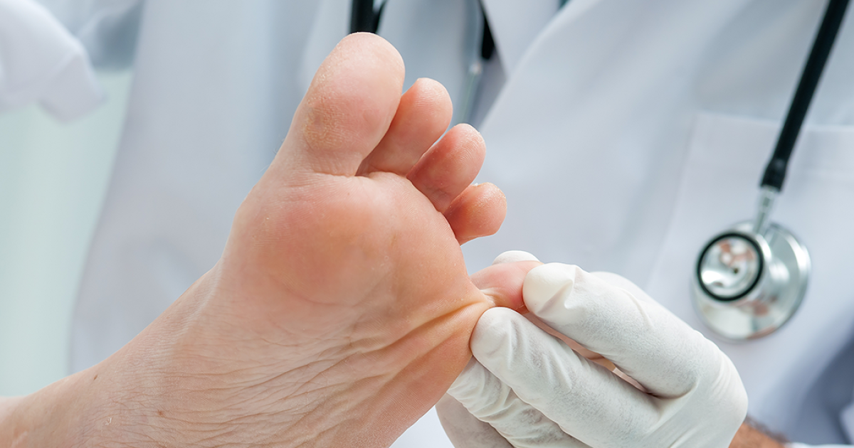 Fungos Nas Unhas Dos Pes Cuf