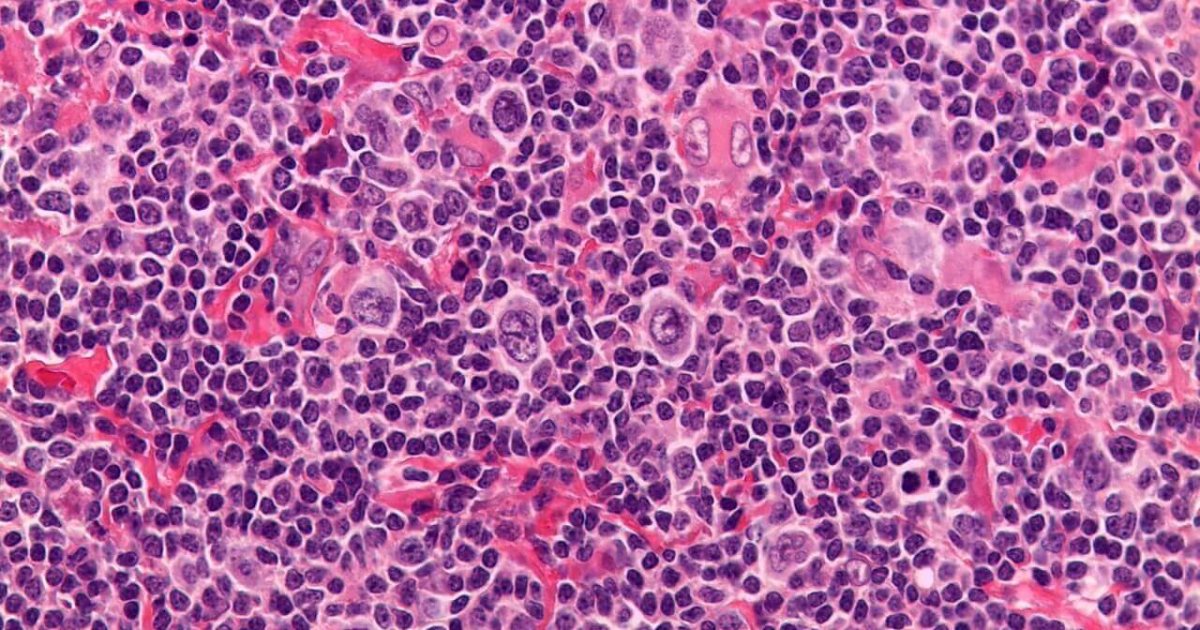 Linfoma de Hodgkin o que é, sintomas e tratamento CUF Linfoma de Hodgkin o que é, sintomas e tratamento CUF