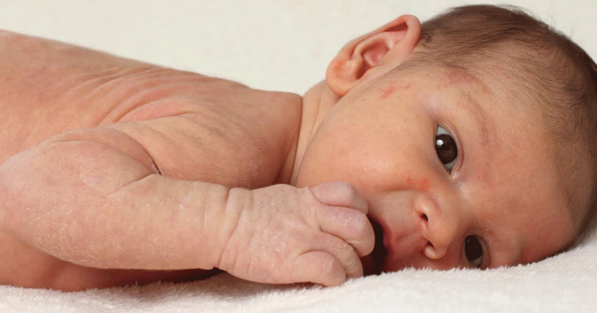 Почему у новорожденного может быть. Ксероз кожи у новорожденных. Мраморность кожных покровов у новорождённых. Мраморная кожа у младенца. Шелушение кожи у новорожденного.