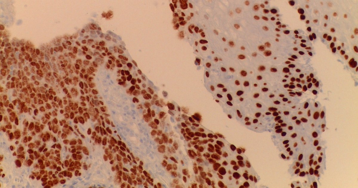 Cancro Da Laringe Cuf