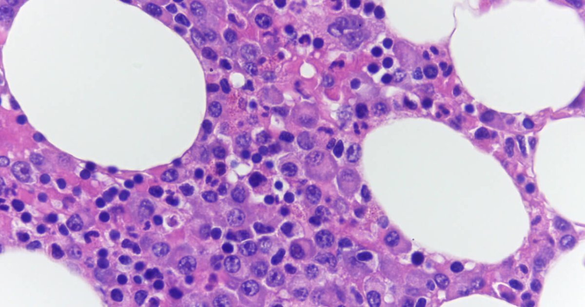 Seminario -medici Mieloma Multiplo - AIL - Foto 4