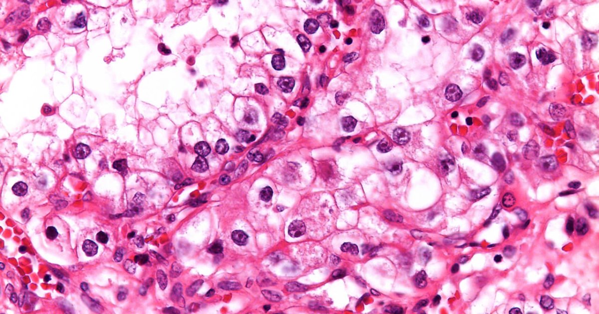 Cancro do Rim: o que é, sintomas e tratamento | CUF