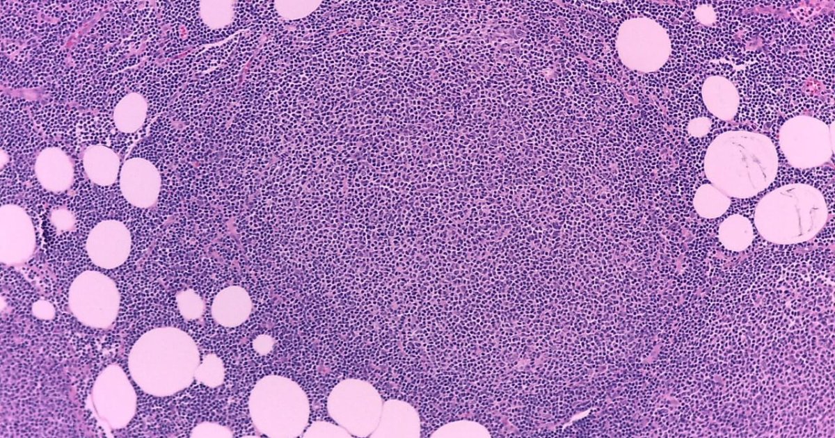 Linfoma não Hodgkin CUF