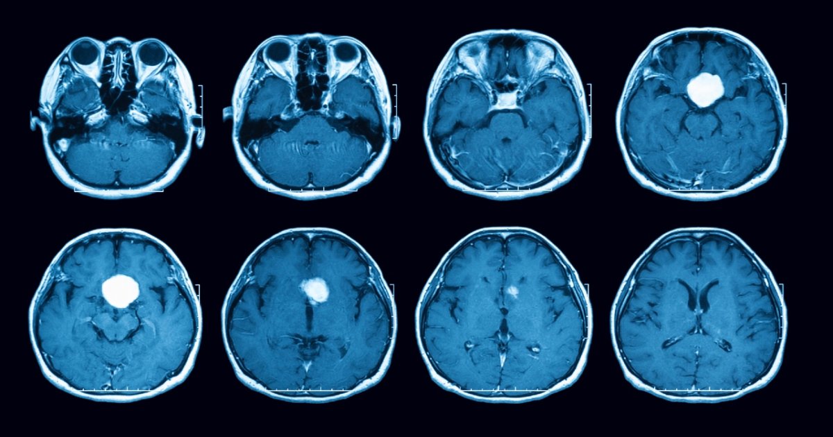 Tumores da hipófise | CUF