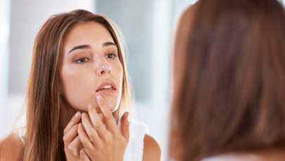 Mulher com acne na idade adulta avalia borbulha ao espelho