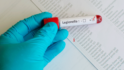 Médico analisa amostra de sangue para diagnóstico de Legionella