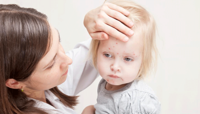 Mãe avalia filha para detetar sintomas de varicela