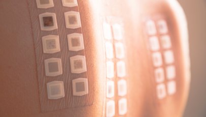 Pessoa com Dermatite de Contacto Alérgica realiza teste epicutâneo (provas de contacto)