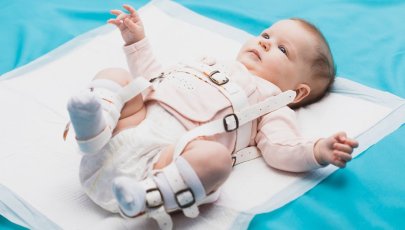 Bebé com displasia da anca utiliza tala para tratamento