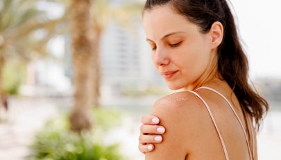 Mulher manifesta sintomas na pele devido a medicamentos que causam sensibilidade ao sol