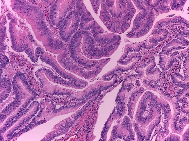 Cancro Cólon e reto